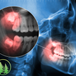 X-ray showing wisdom teeth
