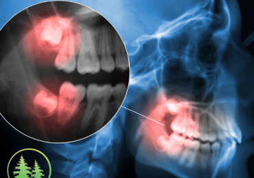 X-ray showing wisdom teeth