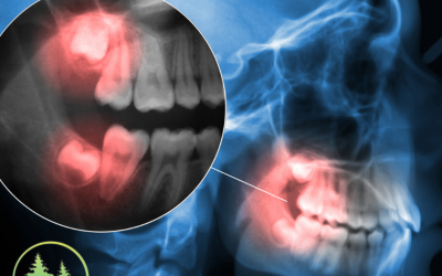 X-ray showing wisdom teeth