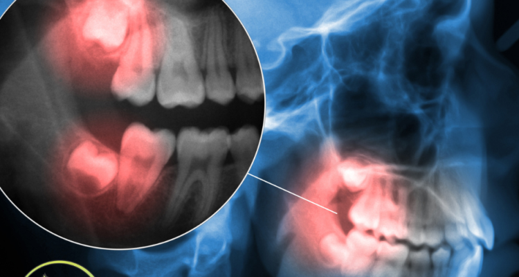 X-ray showing wisdom teeth