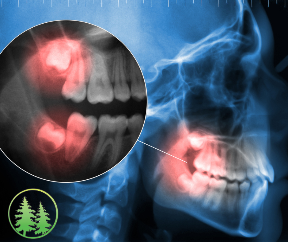 X-ray showing wisdom teeth