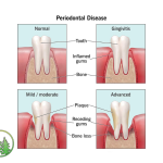 Stages of Periodontal Disease