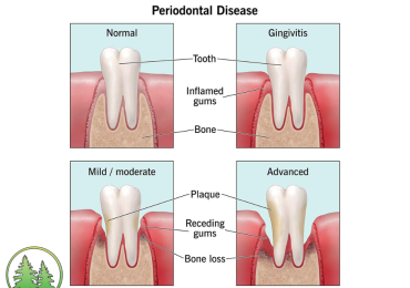 Stages of Periodontal Disease