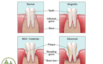 Stages of Periodontal Disease