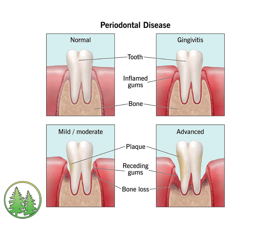 Stages of Periodontal Disease
